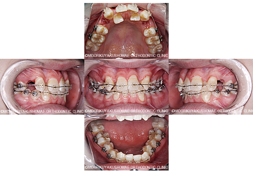 八重歯の矯正治療で抜歯したケース 非抜歯のケース 画像あり 矯正歯科ネット