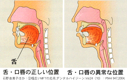 あなたの舌、口唇の位置は正しいですか？