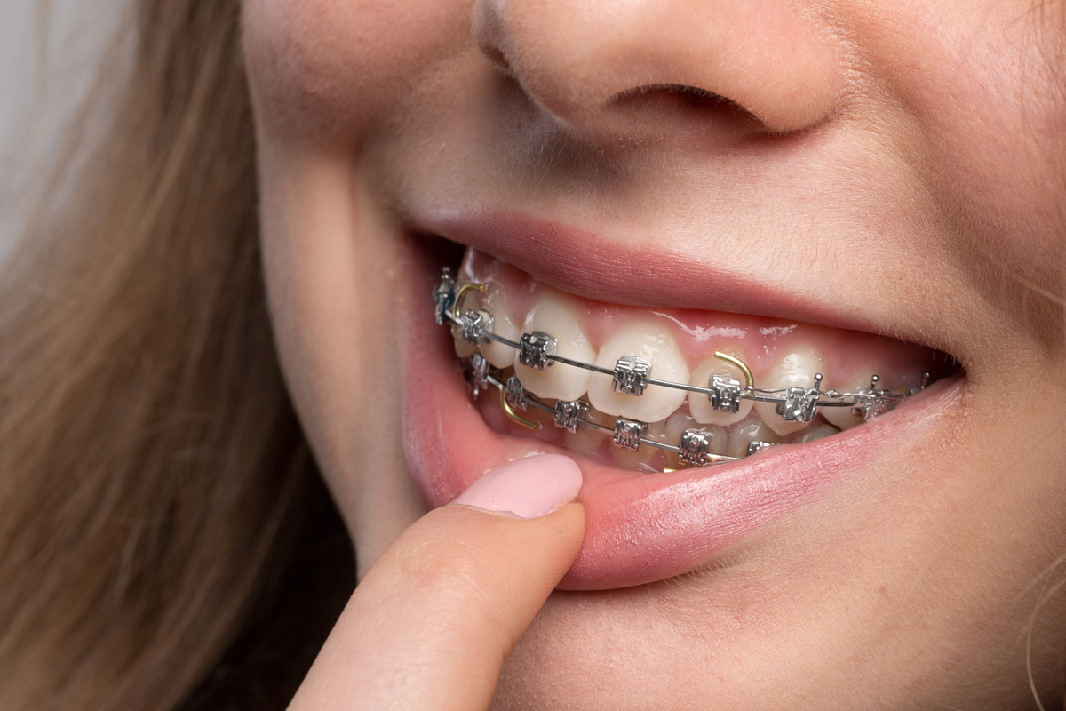 歯列矯正のブラケット装置 種類別メリットデメリット 矯正歯科ネット