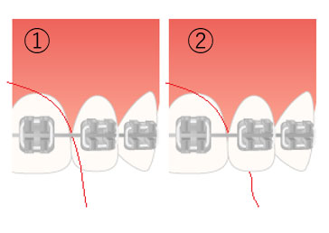 歯と歯の隙間にはフロスを駆使しよう!