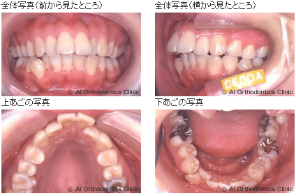 格闘技選手の出っ歯を裏側矯正で対応した症例 矯正歯科ネット