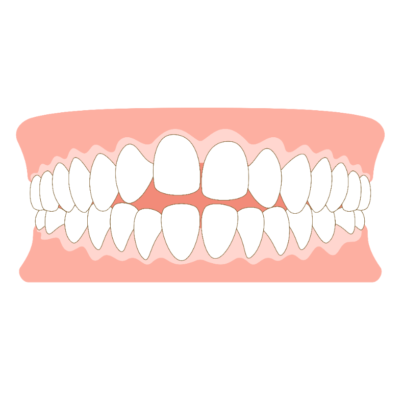 開咬 矯正