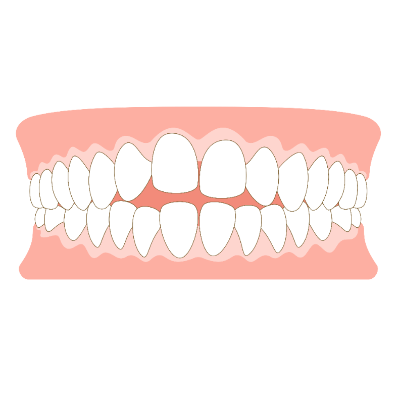 非抜歯 矯正