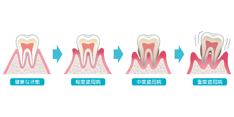 歯周病　原因