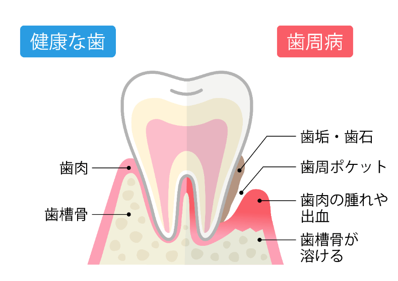 歯周病になる原因とは？症状や治療法、歯周病の予防法を紹介