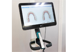 非抜歯での矯正治療