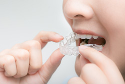 マウスピースの装着開始