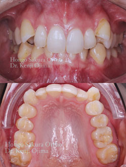 マウスピース矯正でデコボコの歯並びを治療した例 矯正歯科ネット