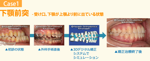 デジタル矯正システムを併用した新しい外科的矯正治療 - 矯正歯科 