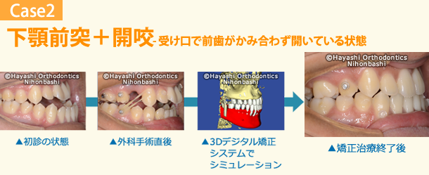 デジタル矯正システムを併用した新しい外科的矯正治療 - 矯正歯科 